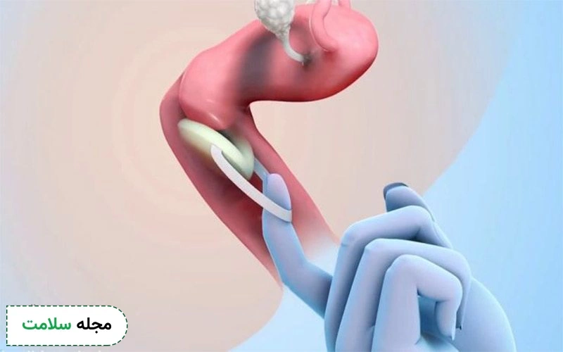 چگونه اسفنج ضد بارداری را خارج کنیم؟