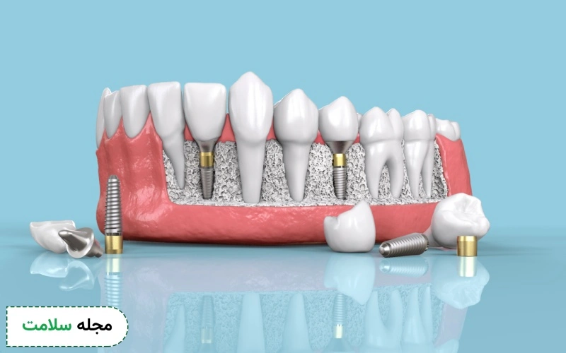 ایمپلنت آمریکایی اینترالاک (Intralock) چیست؟