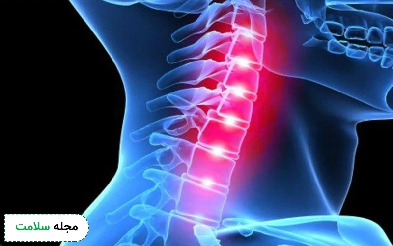 بعد از جراحی دیسککتومی خطر جوش نخوردن مهره‌ها و خارج شدن استخوان پیوندشده از محل خود وجود دارد.
