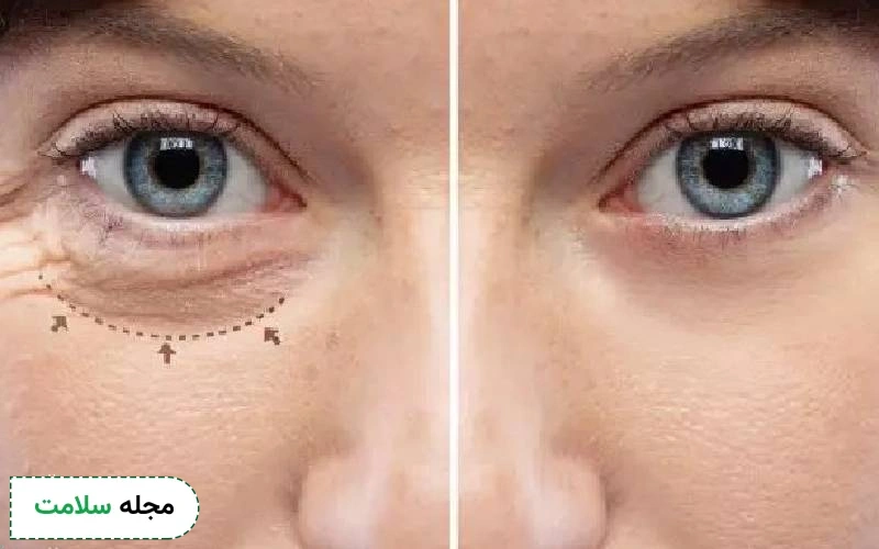 روش های انجام عمل پف زیر چشم و مزایا و معایب آن