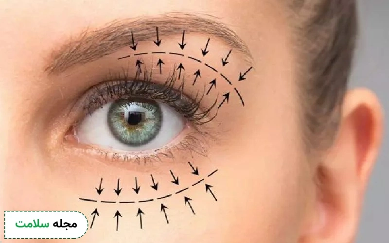 عمل چشم گربه ای یا کانتوپلاستی چیست؟ نحوه انجام این جراحی زیبایی و عوارض آن