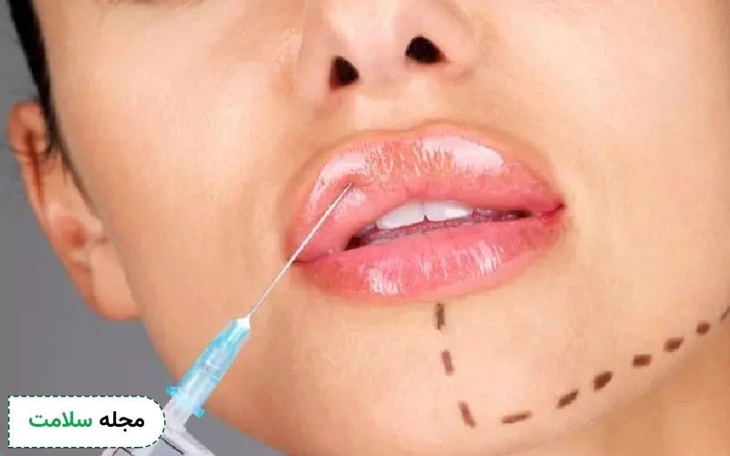 تزریق ژل در جوان‌سازی کدام نواحی صورت و بدن کاربرد دارد؟ بهترین برند ژل کدام است؟