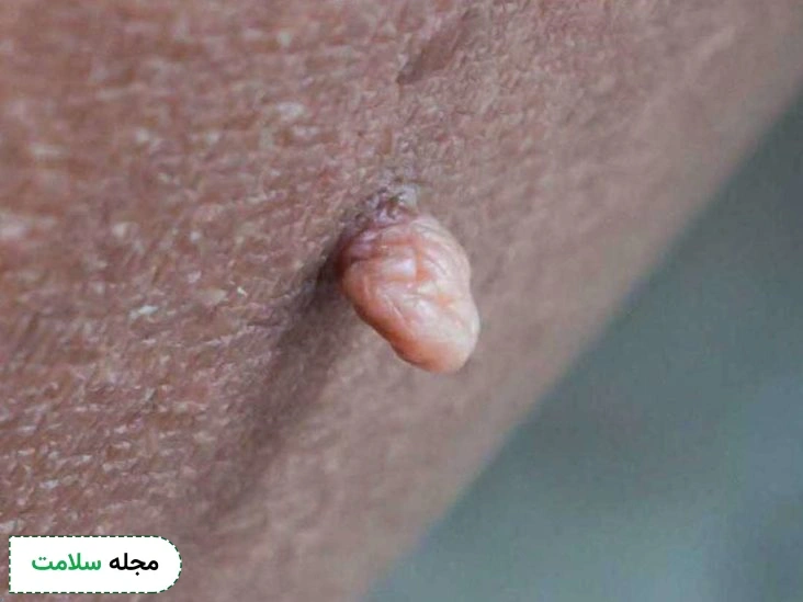 برجستگی-واژن-ناشی-از-بیماری-سیفلیس