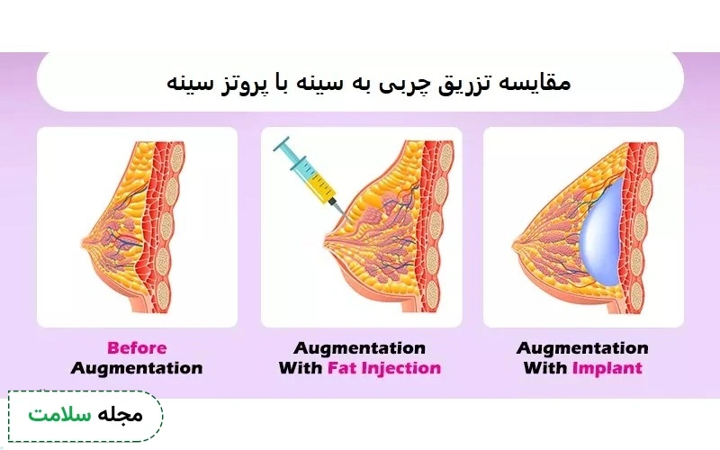تزریق چربی به سینه