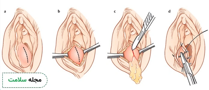 BARTHOLIN CYST