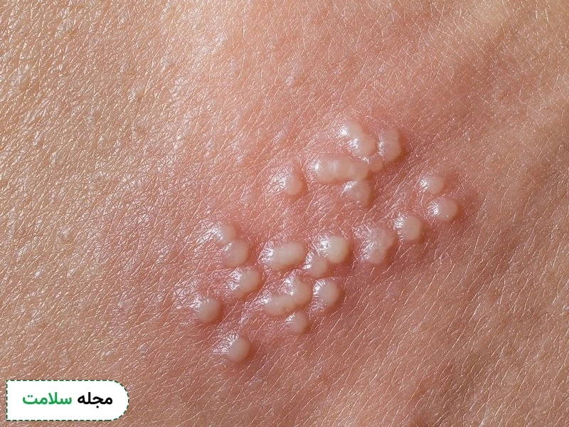 genital herpes