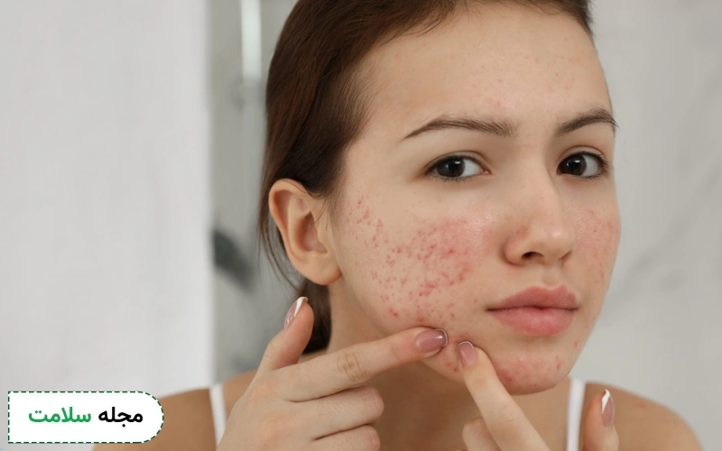 جوش زدن و تخمک گذاری در دختران چه دلیلی دارد؟