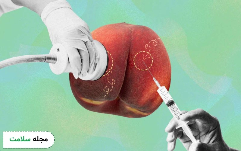 تزریق ژل به باسن؛ بررسی مزایا و عوارض تا انواع مدل آن