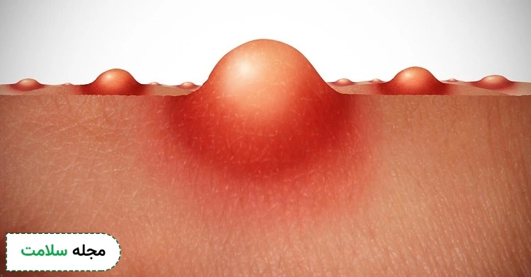 vaginal-pimples