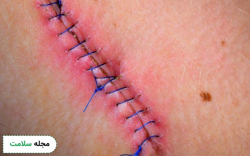 عکس عفونت بخیه زایمان طبیعی
