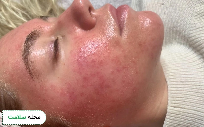 عکس صورت بعد از میکرونیدلینگ