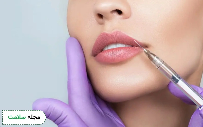 ژل لب روسی چیست؟ همراه با عکس مدل لب روسی