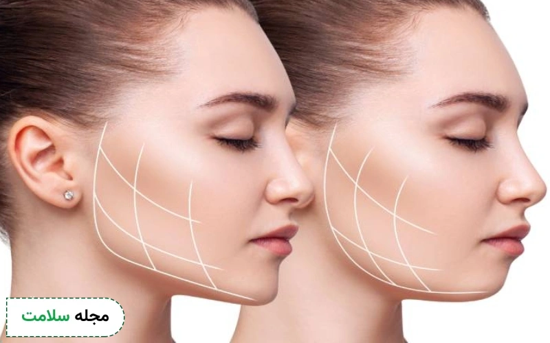 انواع روش زاویه سازی فک کدامند؟