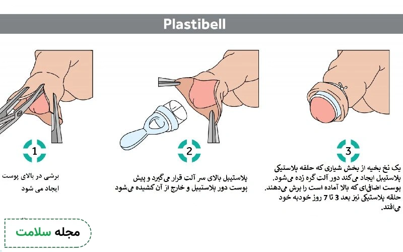 درد ختنه نوزاد چقدر طول میکشد؟
