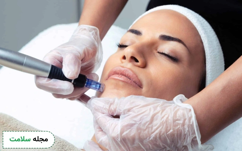 میکرونیدلینگ خانگی چگونه است؟