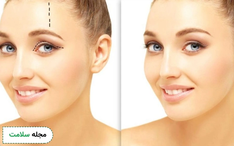 عکس قبل و بعد لیفت شقیقه 