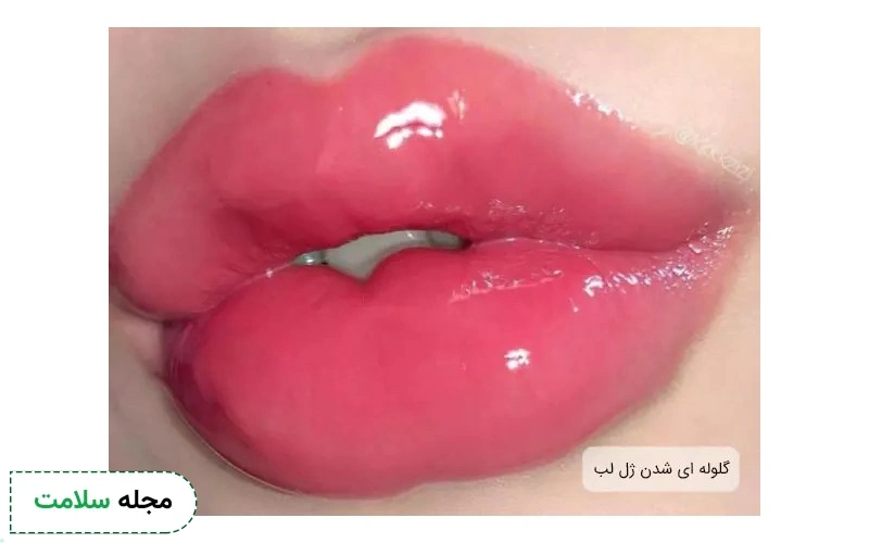 عوارض ژل لب