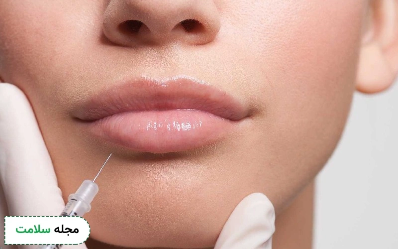 ژل لب و انواع مدل‌های تزریق ژل و فیلر لب برای زیبایی و فرم‌دهی