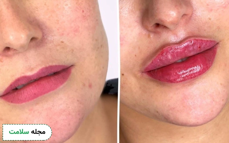 عکس قبل و بعد تزریق ژل لب روسی