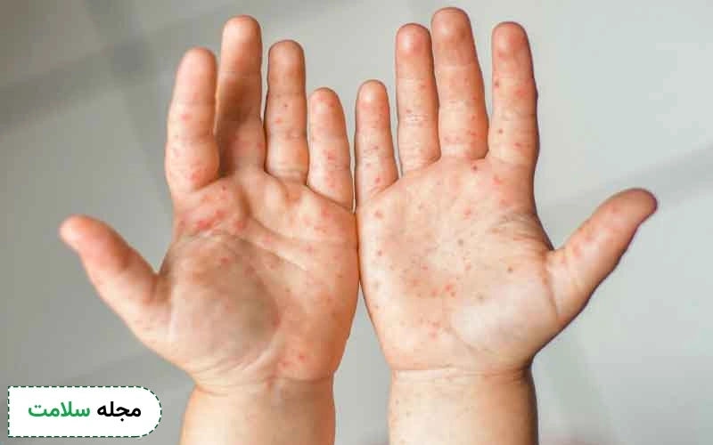 انواع دانه های قرمز روی پوست کودکان ممکن است ایجاد شود.