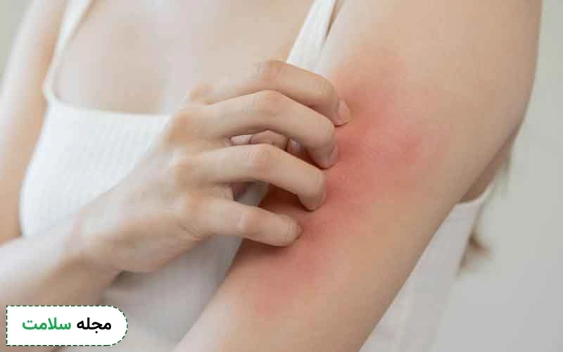 عکس دانه های قرمز روی پوست با خارش
