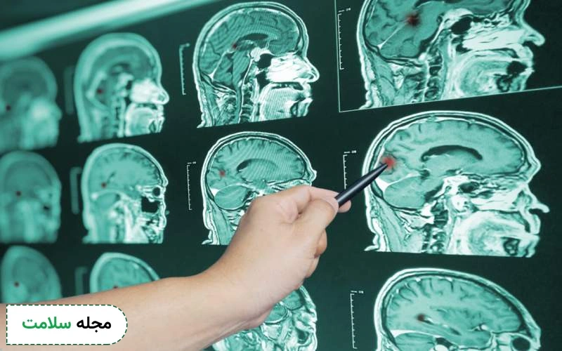 علائم خونریزی مغزی ناشی از ضربه چیست؟