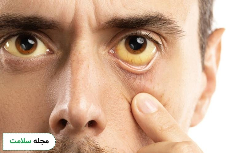 علائم این بیماری بر روی چهره مشخص است.