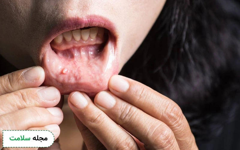 علائم سرطان روی لب چگونه است؟