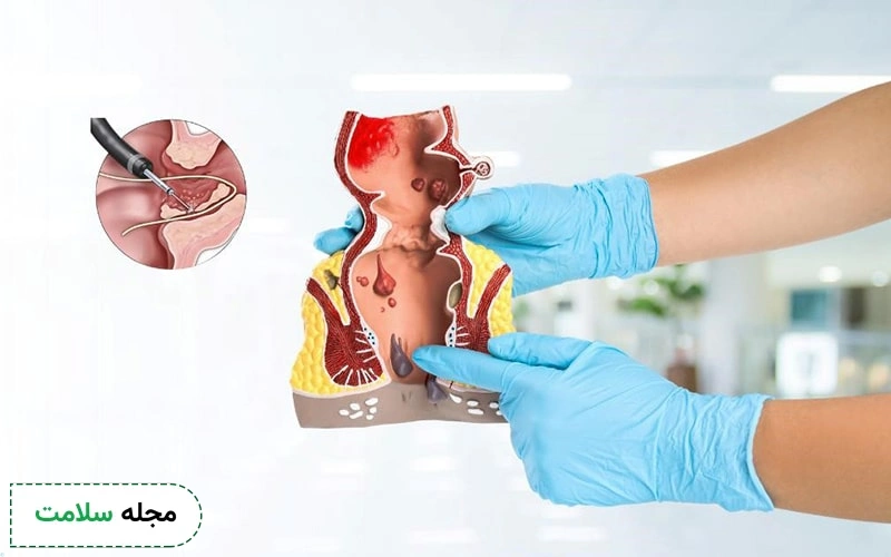 ایجاد فرورفتگی یا سوراخ کوچک روی پوست علت فیستول مویی است.