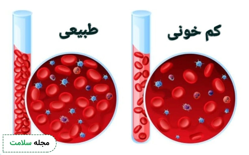 راه ‌های تشخیص گزگز دست و پا ناشی از کم خونی چیست؟