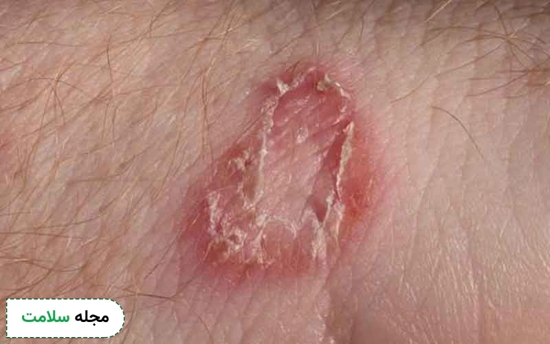 راش پوستی در ناحیه تناسلی چیست؟