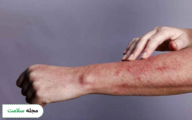 عکس بثورات پوستی ایدز
