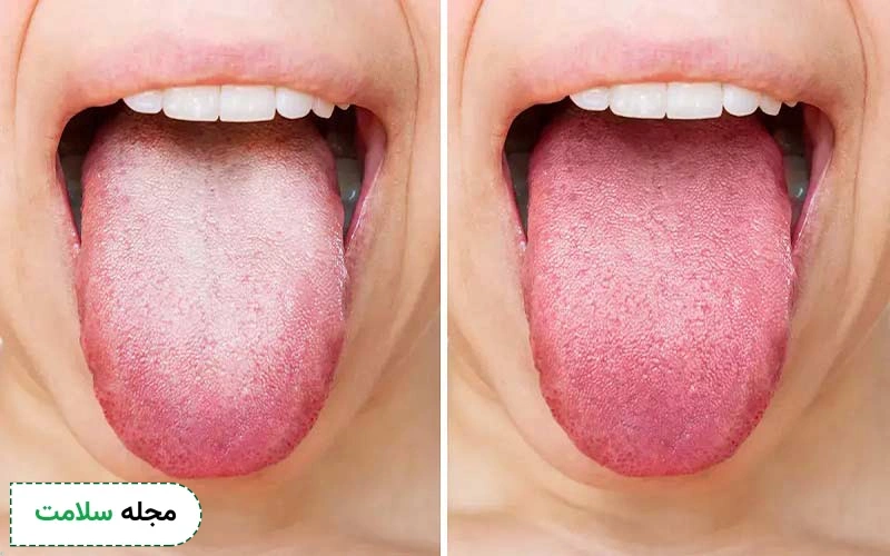 تغییر رنگ و ظاهر از علائم کبد چرب روی زبان است.