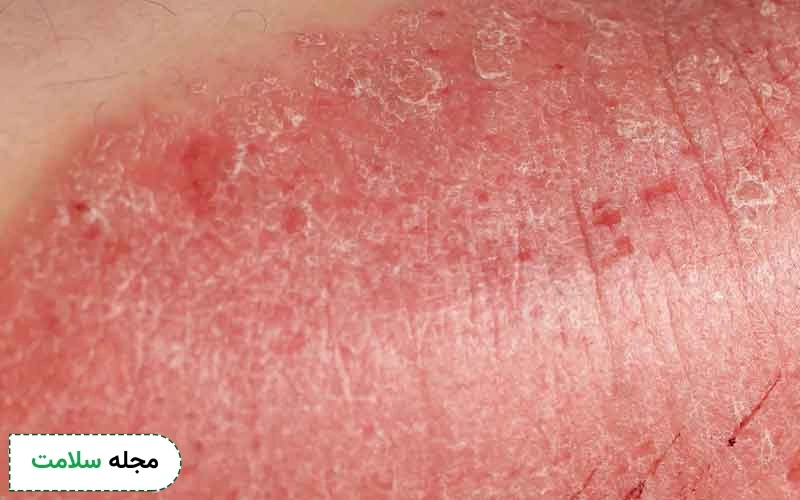 راش پوستی در ناحیه تناسلی به چه دلایلی ایجاد می شود؟