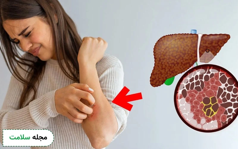 خارش از علائم کبد چرب؛ نشانه ای کمتر شناخته شده اما مهم
