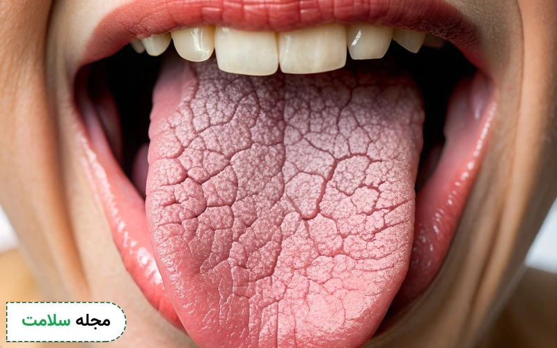 ارتباط صفرا و خشکی دهان چیست؟