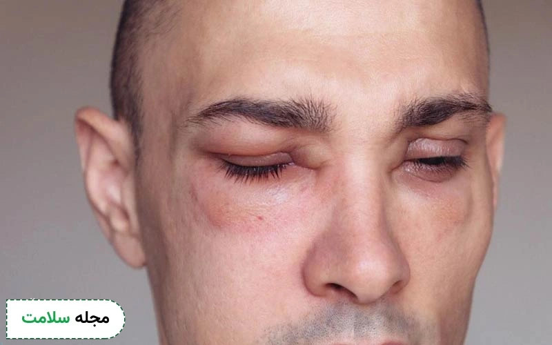 علت ورم صورت بعد از کاشت مو چیست و چگونه مانع بروز آن شویم؟