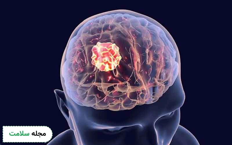 علائم هشدار تومور مغزی در افراد جوان چیست؟