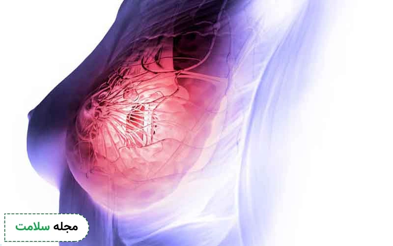 بررسی تمامی علائم متاستاز سرطان سینه به استخوان