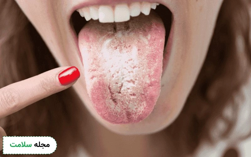 چه بیماری هایی باعث خشکی دهان میشود؟