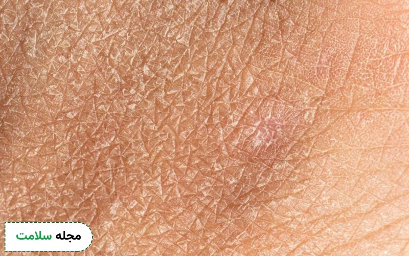 خشکی پوست شدید نشانه چیست؟