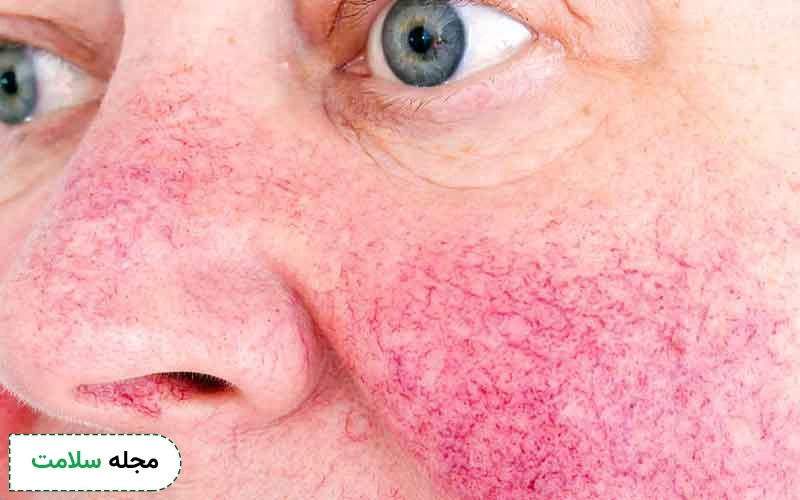 علائم کبد چرب بر روی پوست و چهره چیست؟