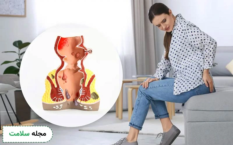 علائم بواسیر در زنان چگونه خود را نشان می دهند؟