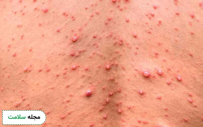 رنگ پریدگی و زخم های دهانی از علائم راش پوستی ایدز است.