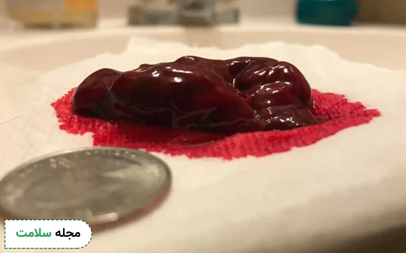 آیا لخته خون گوشتی در قاعدگی خطرناک است؟