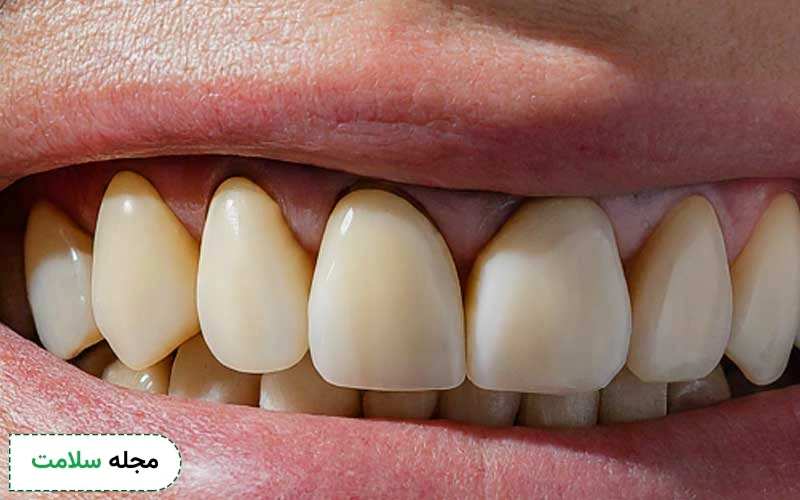 سیاه شدن لثه دندان روکش شده چیست؟