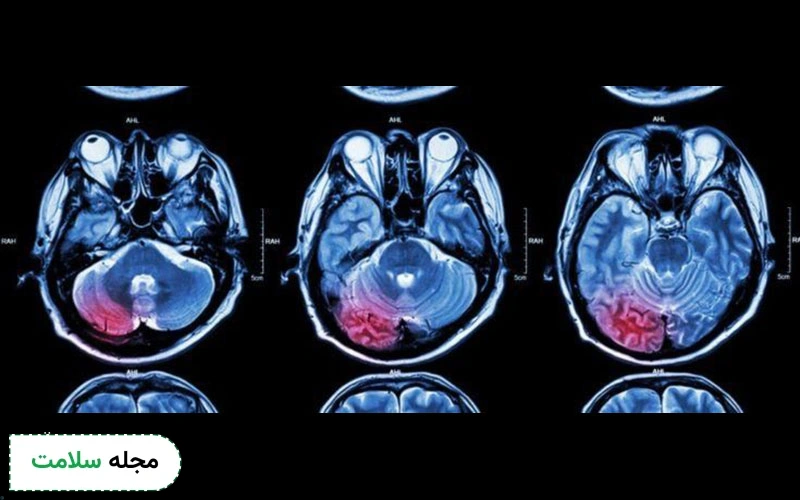 چند نوع تومور مغزی وجود دارد؟
