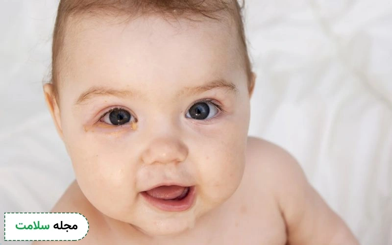 چه زمانی عفونت چشم کودک نیاز به مراجعه به پزشک دارد؟