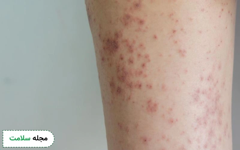 مرحله چهارم جوش آبله مرغان چیست؟