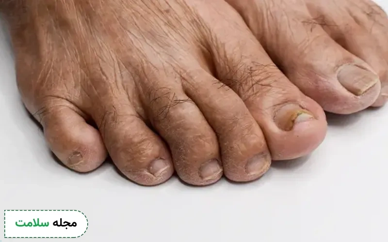 اقدامات اولیه در خانه برای سیاه شدن انگشت پا دیابتی چیست؟